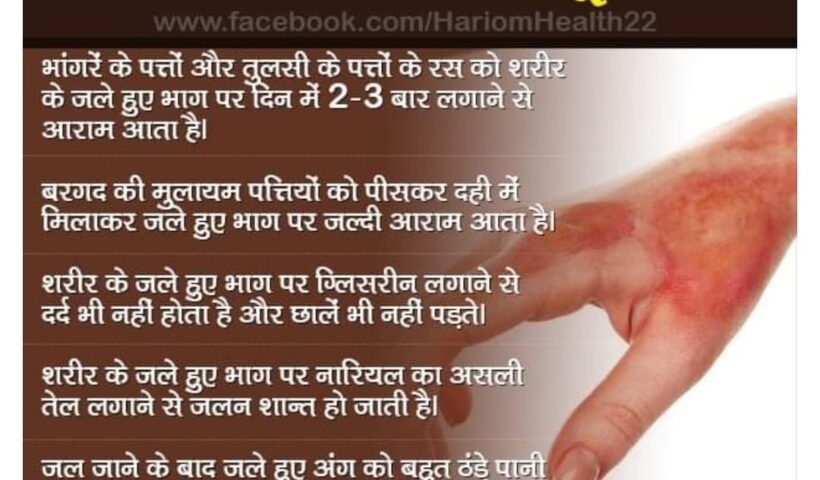 Home remedies for burns